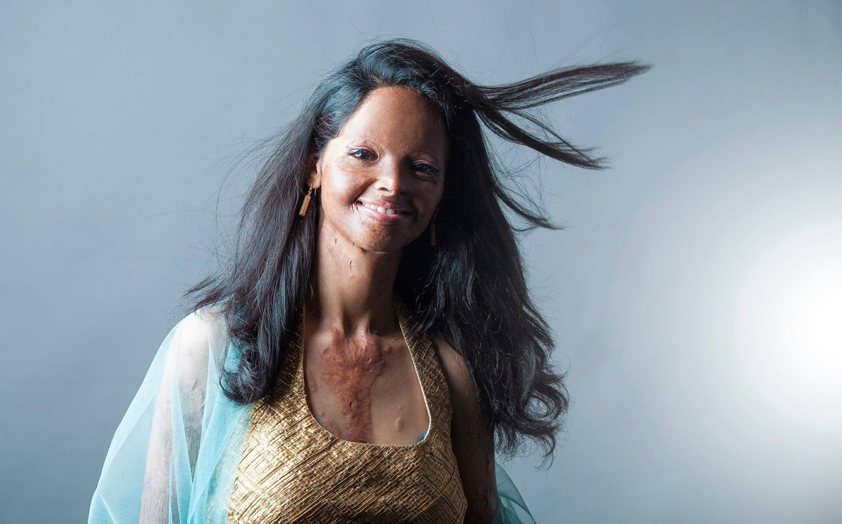 Show Acid Attack Survivors, una sèrie de fotografies brutal